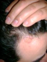 scalp psoriasis after 2 weeks